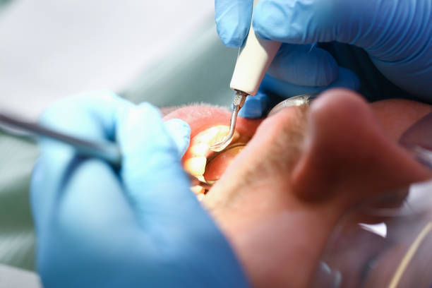 Best Dental Abscess Treatment in Clinton, MO
