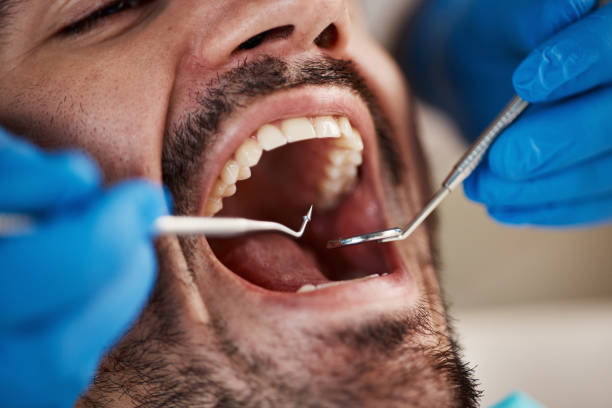 Best Dental Abscess Treatment in Clinton, MO